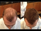 Hair Regrowth Products For Men, Stem Cell Hair Regrowth, Best Hair Regrowth Method, Hair Regrowth