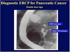 Current Diagnostic Tools for Pancreatic Cancer