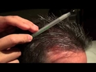 How Hair Grows on the Head Lecture by Hair-Transplant Surgeon Dr. Sam Lam